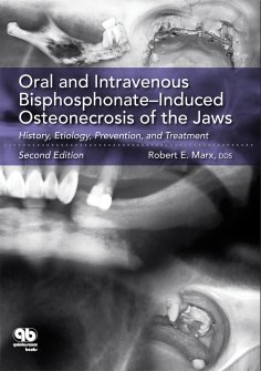 ebook: Oral and Intravenous Bisphosphonate–Induced Osteonecrosis of the Jaws