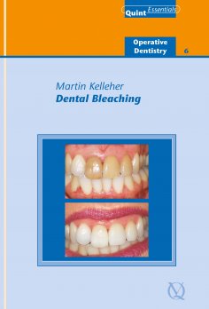 ebook: Dental Bleaching