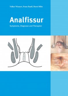 eBook: Analfissur