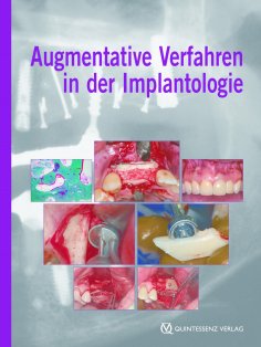 eBook: Augmentative Verfahren in der Implantologie