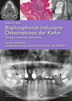 ebook: Bisphosphonat-induzierte Osteonekrose der Kiefer